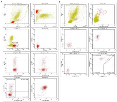 Case report: Waldenstrom macroglobulinemia with systemic amyloidosis as the main manifestation